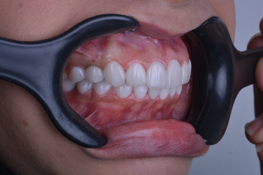 بعد تغير لون و شكل الأسنان لإعادة تأهيل الابتسامة.